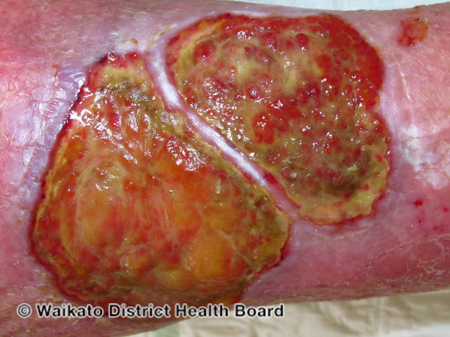 File:Chronic ulcer (DermNet NZ bacterial-w-biofilm-2).jpg