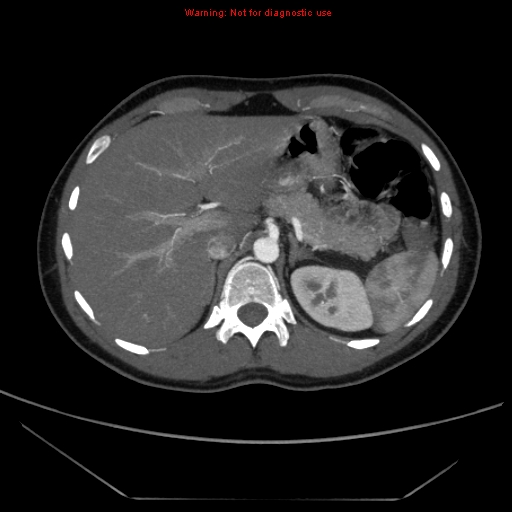 File:Circumaortic left renal vein (Radiopaedia 9069-9792 A 1).jpg