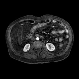 File:Cirrhosis and hepatocellular carcinoma in the setting of hemochromatosis (Radiopaedia 75394-86594 Axial T1 C+ fat sat 96).jpg
