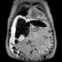 File:Cirrhosis and hepatocellular carcinoma in the setting of hemochromatosis (Radiopaedia 75394-86594 Coronal T2 7).jpg
