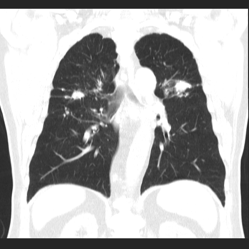 File:Classic complicated silicosis (Radiopaedia 49720-54961 Coronal lung window 40).jpg