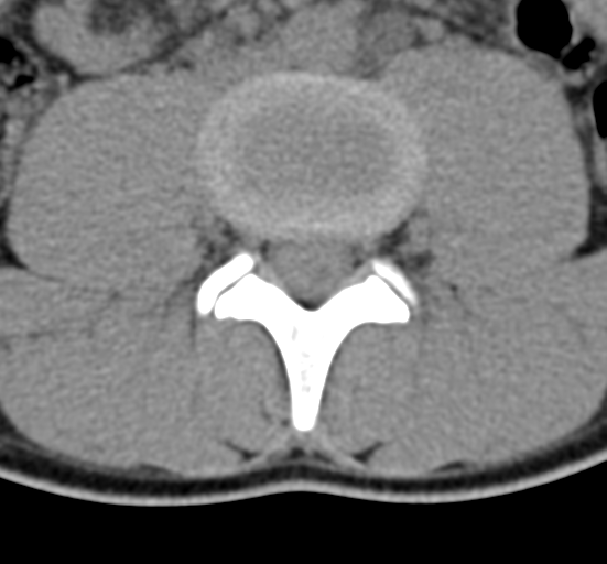 Clear cell meningoma - lumbar spine (Radiopaedia 60116-67691 Axial non-contrast 44).png