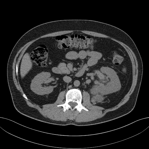 File:Clear cell renal cell carcinoma (Radiopaedia 61449-69393 Axial non-contrast 38).jpg