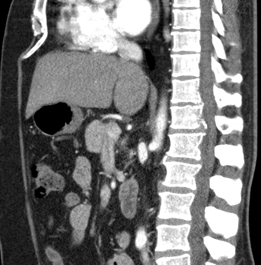 File:Clear cell renal cell carcinoma (Radiopaedia 61449-69393 D 58).jpg