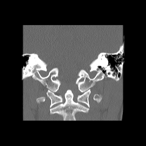 File:Cleft hard palate and alveolus (Radiopaedia 63180-71710 Coronal bone window 41).jpg