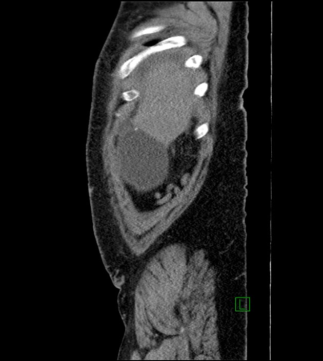 Closed-loop small bowel obstruction-internal hernia (Radiopaedia 78439-91096 C 128).jpg