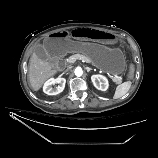 Closed loop obstruction due to adhesive band, resulting in small bowel ischemia and resection (Radiopaedia 83835-99023 B 50).jpg