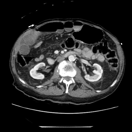 File:Closed loop small bowel obstruction - adhesive disease and hemorrhagic ischemia (Radiopaedia 86831-102990 A 86).jpg
