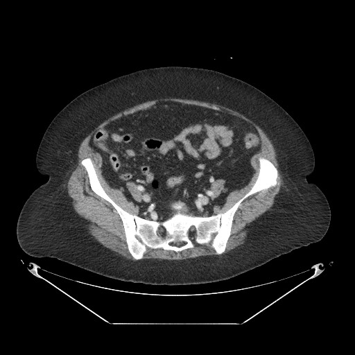 Closed loop small bowel obstruction - internal hernia (Radiopaedia 65402-74450 A 97).jpg
