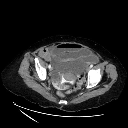 File:Closed loop small bowel obstruction due to adhesive band, with intramural hemorrhage and ischemia (Radiopaedia 83831-99017 Axial 96).jpg