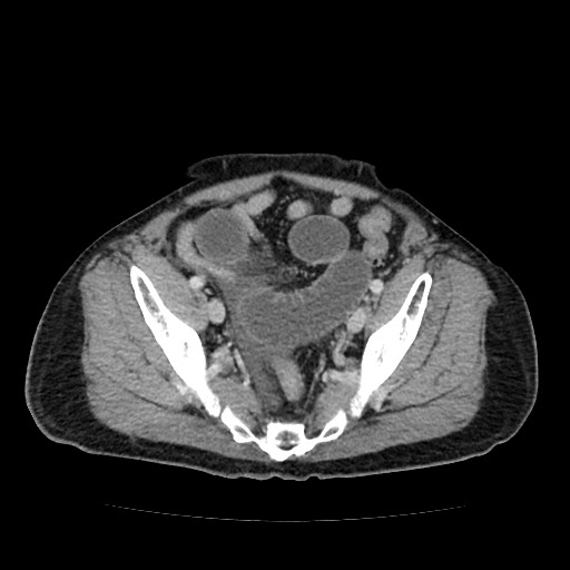 File:Closed loop small bowel obstruction due to adhesive band - U-shaped loop (Radiopaedia 83829-99012 A 57).jpg