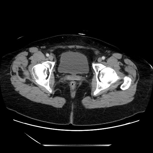 Closed loop small bowel obstruction due to adhesive bands - early and late images (Radiopaedia 83830-99014 A 148).jpg