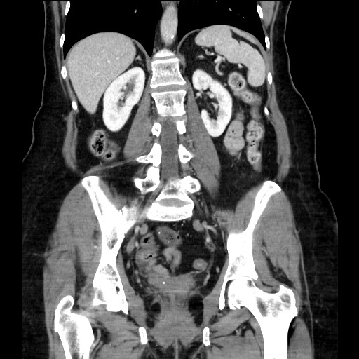 Closed loop small bowel obstruction due to adhesive bands - early and late images (Radiopaedia 83830-99014 B 82).jpg