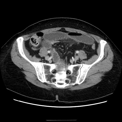 Closed loop small bowel obstruction due to adhesive bands - early and late images (Radiopaedia 83830-99015 A 125).jpg
