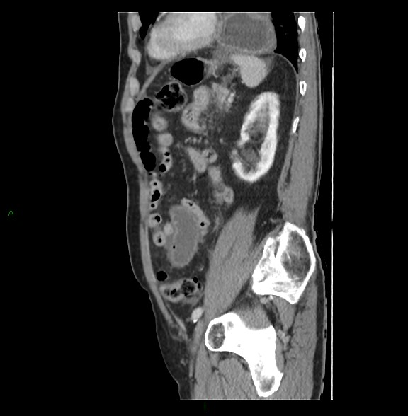 File:Closed loop small bowel obstruction with ischemia (Radiopaedia 84180-99456 C 65).jpg