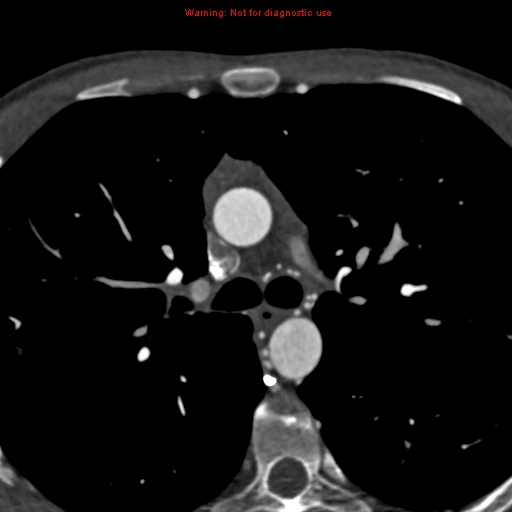 File:Coarctation of the aorta (Radiopaedia 12461-12697 A 154).jpg