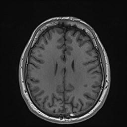 File:Cochlear incomplete partition type III associated with hypothalamic hamartoma (Radiopaedia 88756-105498 Axial T1 130).jpg