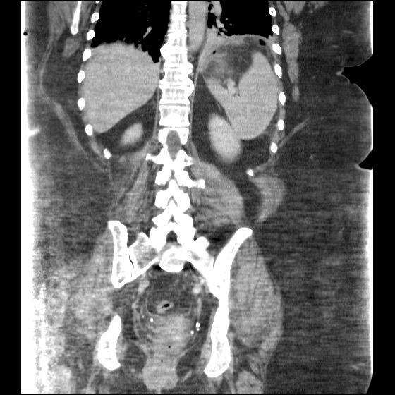 File:Collection due to leak after sleeve gastrectomy (Radiopaedia 55504-61972 B 34).jpg