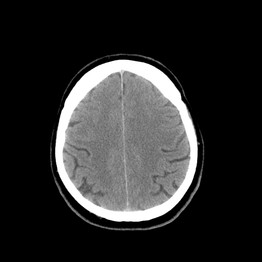 File:Colloid cyst (large) (Radiopaedia 34415-35734 Axial non-contrast 44).png