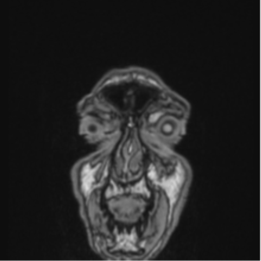 Colloid cyst of the third ventricle (Radiopaedia 86571-102662 Coronal T1 89).png