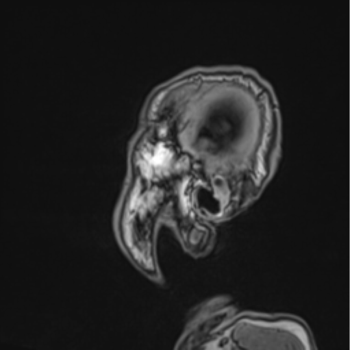 Colloid cyst of the third ventricle (Radiopaedia 86571-102662 Sagittal T1 73).png