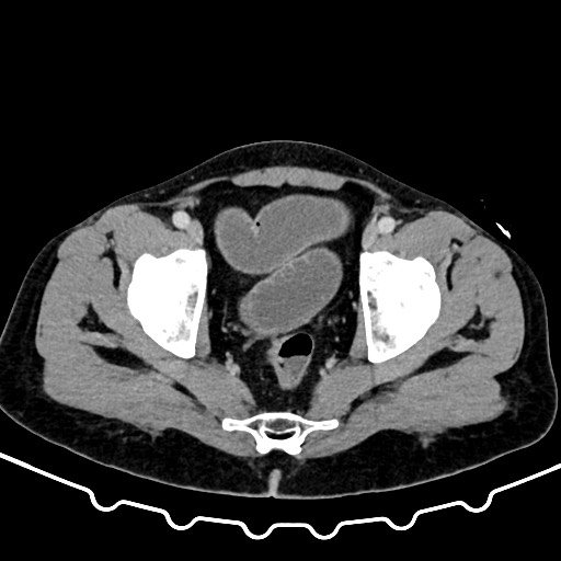 Colocolic intussusception due to large lipoma (Radiopaedia 68773-78482 A 173).jpg