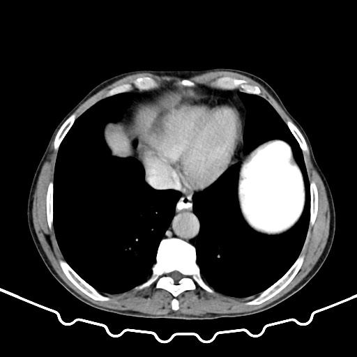 File:Colocolic intussusception due to large lipoma (Radiopaedia 68773-78482 Axial 101).jpg