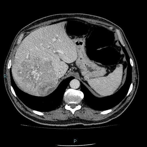 Colon adenocarcinoma with calcific liver metastasis (Radiopaedia 55745-62300 B 7).jpg