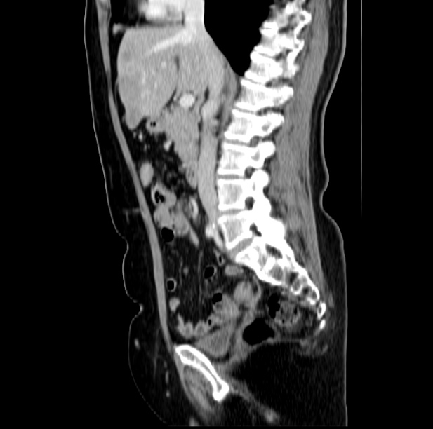 Colon carcinoma with hepatic metastases (Radiopaedia 29477-29961 C 25).jpg