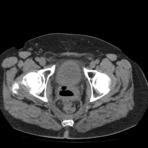 File:Colonic fistula (Radiopaedia 16047-15707 Axial non-contrast 62).jpg