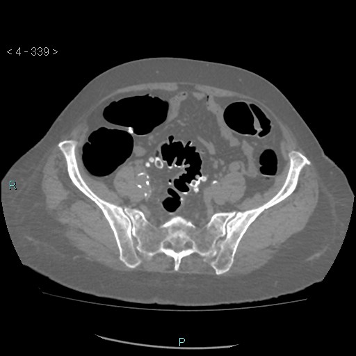 File:Colonic lipomas (Radiopaedia 49137-54244 Axial bone window 151).jpg
