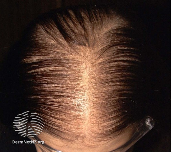 File:Grade 3 hair loss (DermNet NZ fphl2).jpg