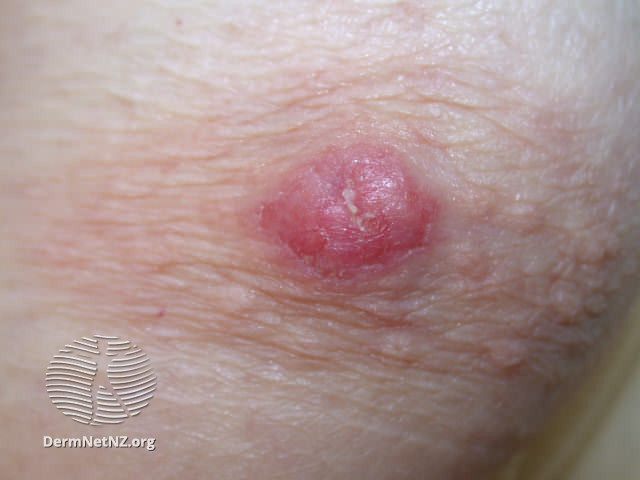 File:Mammary Paget disease of the skin (DermNet NZ mammary-paget-07).jpg