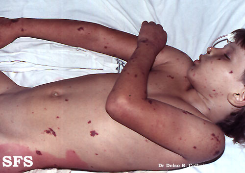 File:Meningitis (Dermatology Atlas 1).jpg