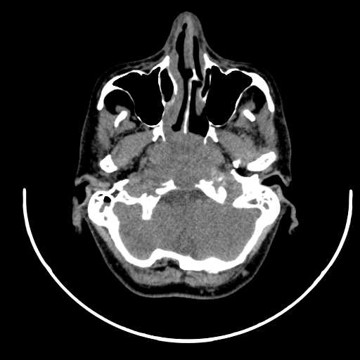 File:Nasopharyngeal carcinoma - infiltrating the clivus (Radiopaedia 62583-70875 Axial non-contrast 14).jpg