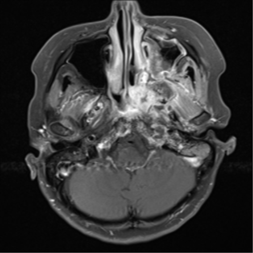 File:Nasopharyngeal carcinoma with cerebral abscess (Radiopaedia 43018-46273 Axial T1 C+ fat sat 16).png