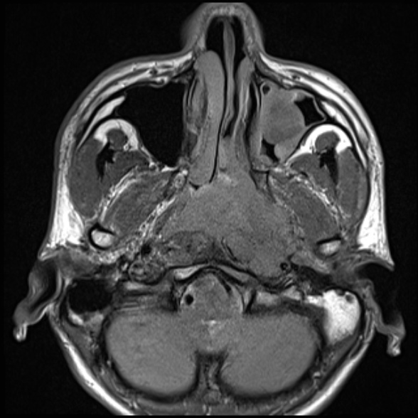 Nasopharyngeal carcinoma with skull base invasion (Radiopaedia 53415-59485 Axial T1 27).jpg
