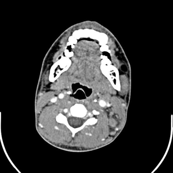 Nasopharyngeal carcinoma with skull base invasion (Radiopaedia 53415-59705 A 111).jpg
