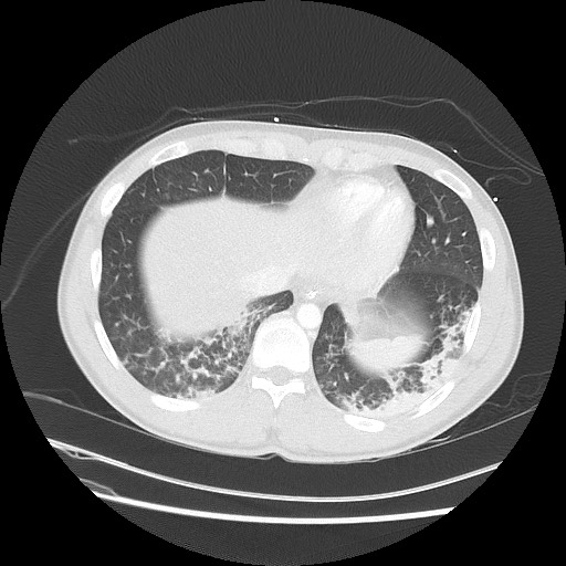 Near-drowning pulmonary edema (Radiopaedia 59457-66814 Axial lung window 46).jpg