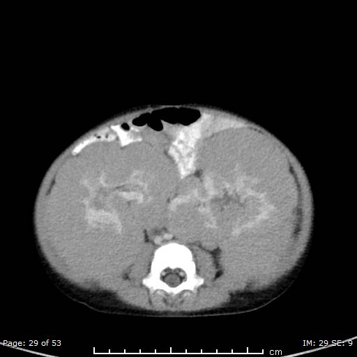 Nephroblastomatosis (Radiopaedia 41934-44935 A 29).jpg