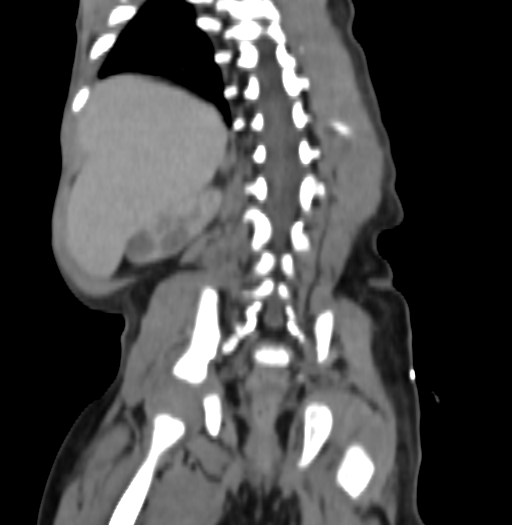 Nephroblastomatosis (Radiopaedia 71294-81607 B 272).jpg