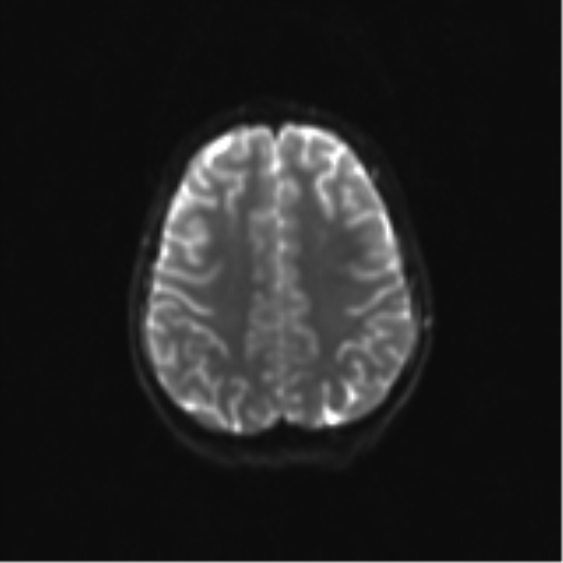 Neurenteric cyst (Radiopaedia 58641-65837 Axial DWI 27).png