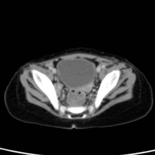Neuroblastoma with skull metastases (Radiopaedia 30326-30960 C 53).jpg