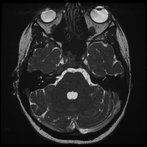 Neurofibromatosis type 2 - bilateral acoustic neuromata (Radiopaedia 40060-42566 Axial FIESTA 48).png