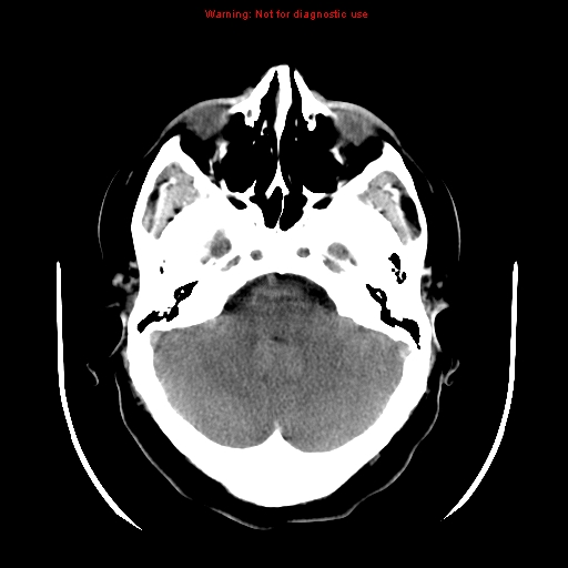 File:Neuroglial cyst (Radiopaedia 10713-11185 Axial non-contrast 25).jpg