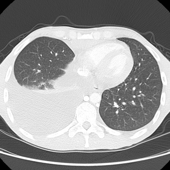 File:Non-Hodgkin lymphoma involving lung (Radiopaedia 29094-29470 Axial lung window 49).jpg