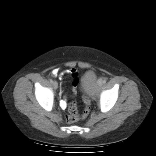File:Non-Hodgkin lymphoma involving pelvis (Radiopaedia 21281-21197 A 54).jpg