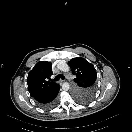 File:Non Hodgkin lymphoma in a patient with ankylosing spondylitis (Radiopaedia 84323-99621 B 13).jpg