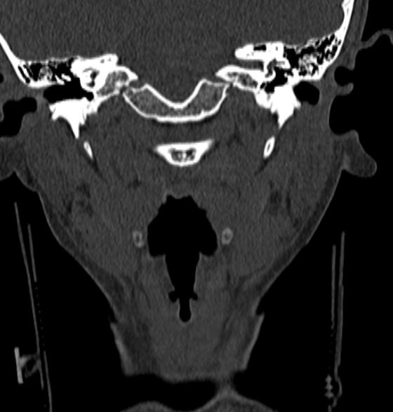 File:Normal CT cervical spine - 12-year-old (Radiopaedia 55352-61775 Coronal bone window 25).jpg