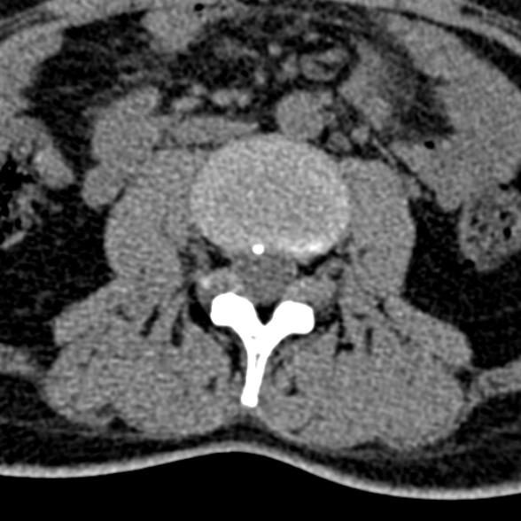 Normal CT lumbar spine (Radiopaedia 53981-60118 Axial non-contrast 54).jpg